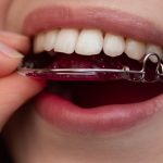 The Benefits of Braces from Liverpool's Leading Orthodontists