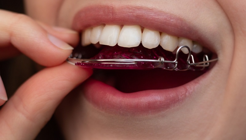 The Benefits of Braces from Liverpool’s Leading Orthodontists